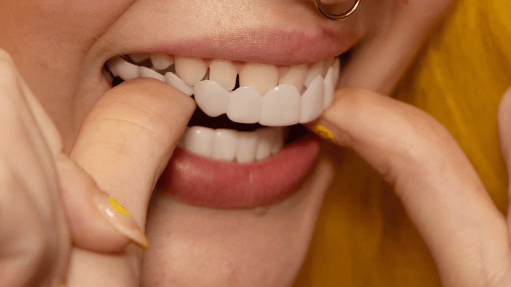 Snap-On Smile Veneers (Upper & Lower)