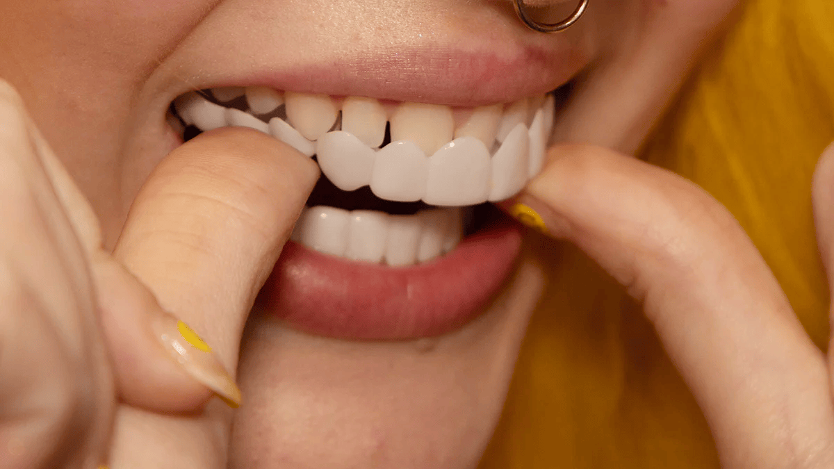 Snap-On Smile Veneers (Upper & Lower)