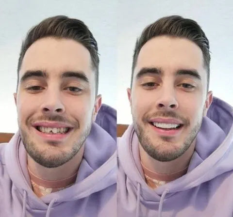 Na Smile Veneers (včetně horní a dolní čelisti)