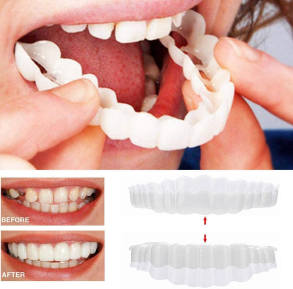 Na Smile Veneers (včetně horní a dolní čelisti)