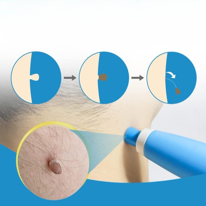 Skin Tag Removal Kit – Painless Micro-Compression Technology
