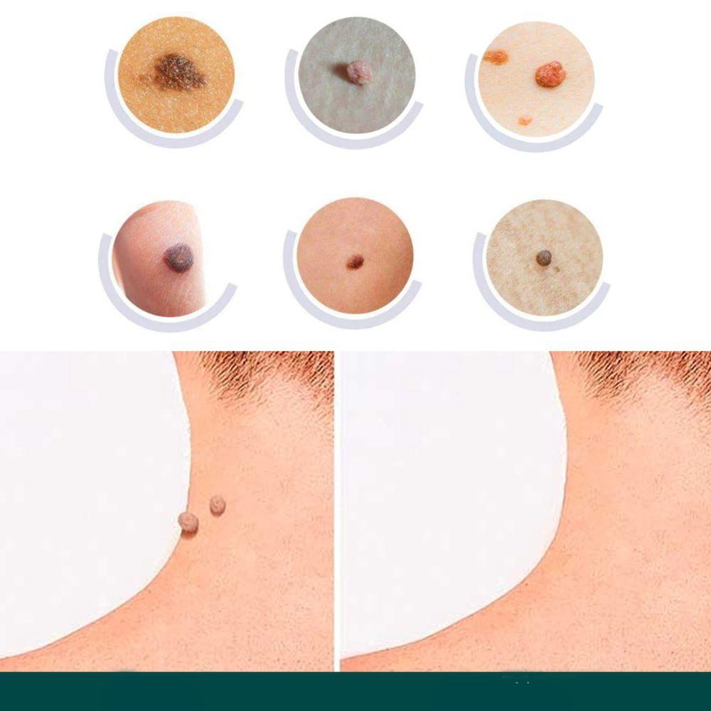 SkinClear Skin Tag Remover | Patches for Removing Skin Tags & Warts | Hydrocolloid Technology | Painless & Discreet | For All Skin Types | 120 Pieces