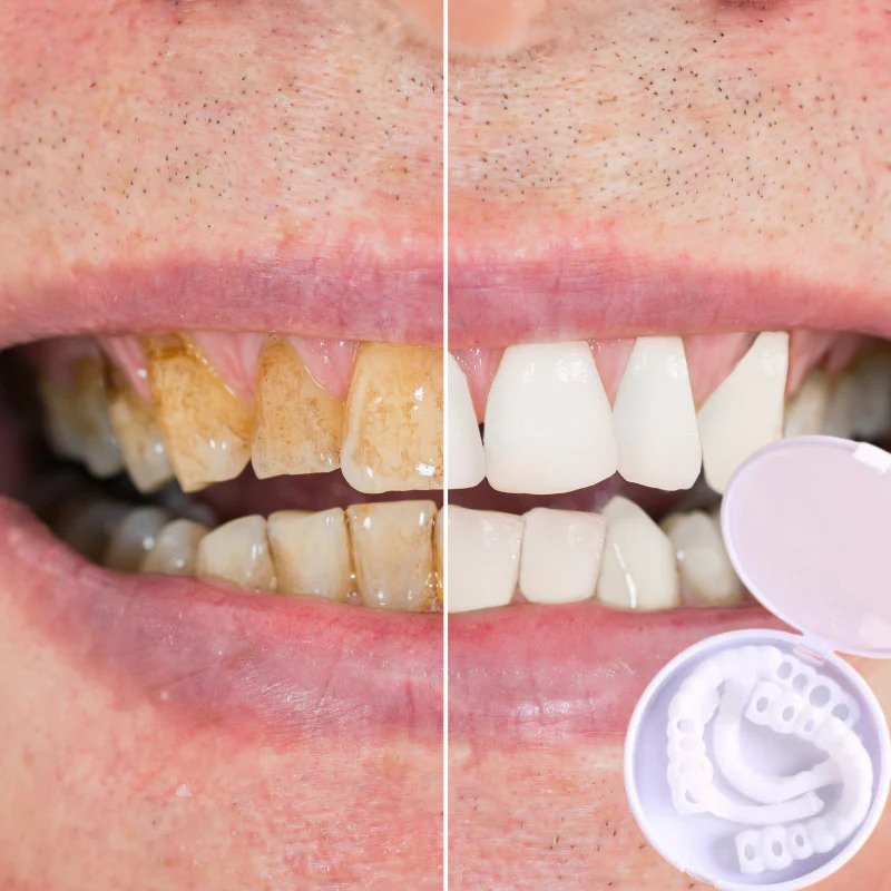 Veneers | Flexible Passform ohne Klebstoff | Für Essen Trinken und Alltag | SnapSmile