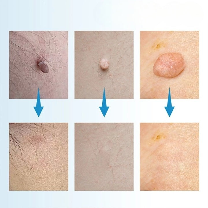 Skin Tag Removal Kit – Painless Micro-Compression Technology